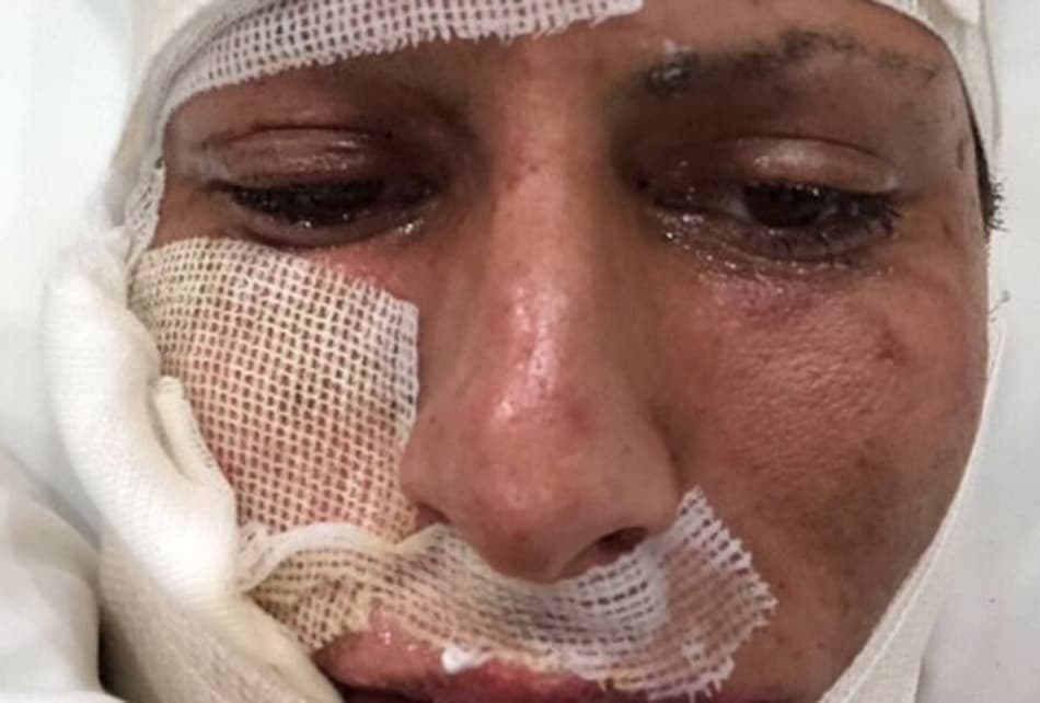 Jogador do Tigres sofre queimadura no rosto e no corpo após soltar fogos