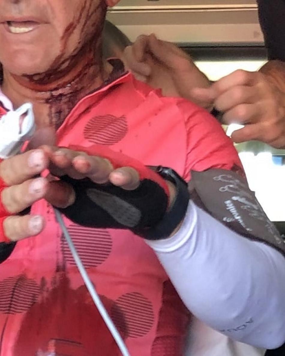 Tiros no rosto! Ex-piloto da Moto GP mostra resultado de atentado sofrido