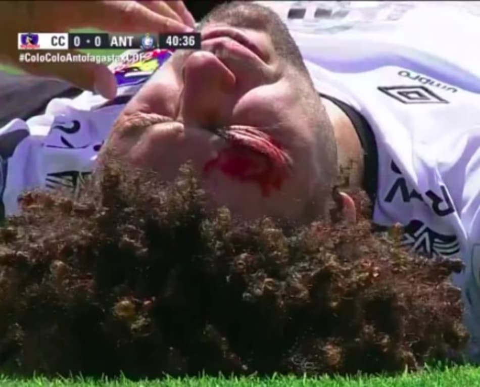 Imagem Forte! Após choque com adversário, zagueiro sofre corte no rosto