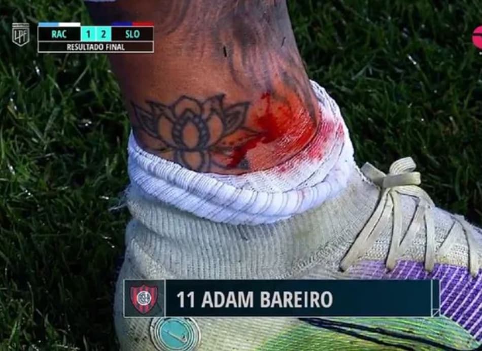 Imagem forte! Jogador leva entrada do adversário e sai machucado do lance