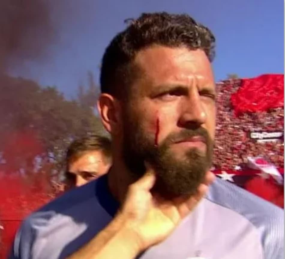 Goleiro é atingido por bomba e tem rosto cortado