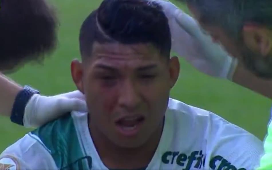 Atacante do Palmeiras leva chute no olho; médico oftalmologista Alex Sá aponta riscos