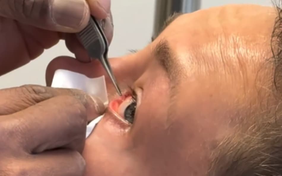 Lutadora americana Rose Namajunas retira tubo do olho esquerdo (Reprodução)