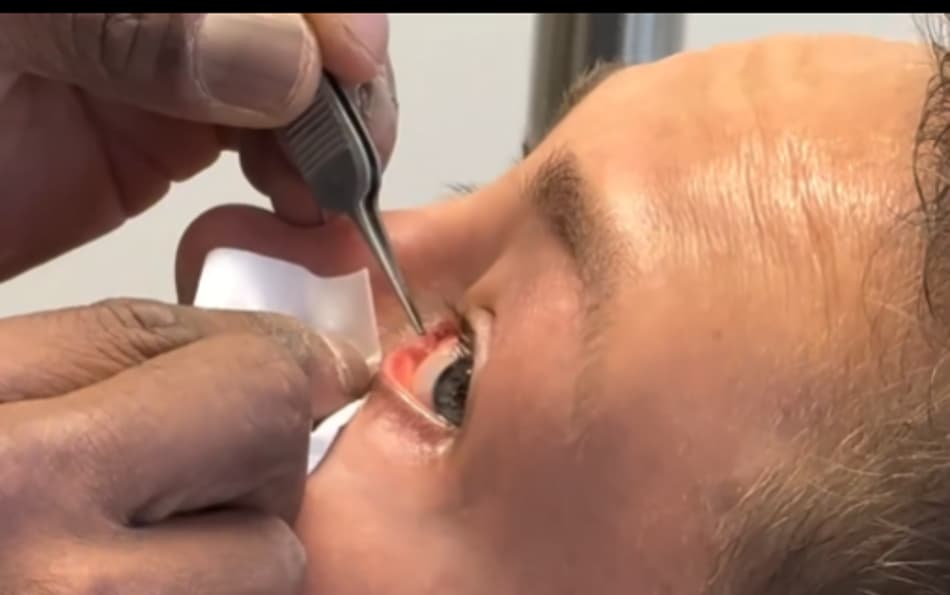 Lutadora americana Rose Namajunas retira tubo do olho esquerdo (Reprodução)