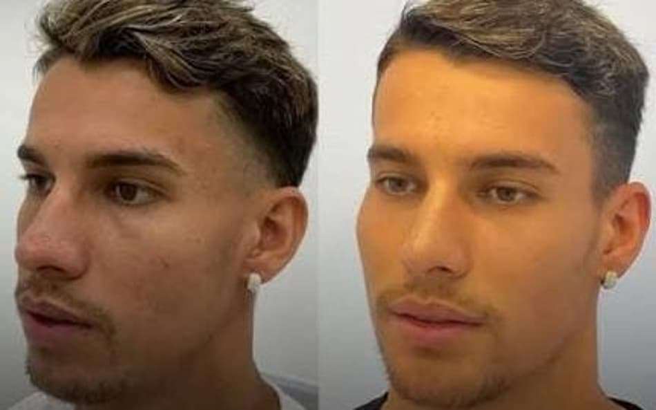 Atletas já divulgaram oficialmente nas redes que realizaram procedimentos (Foto: Reprodução)