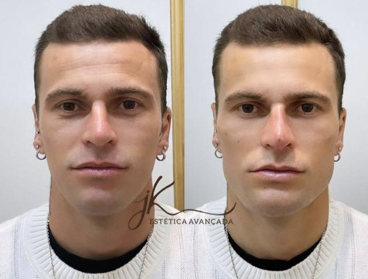 Harmonização facial: o que é, antes e depois e quanto custa