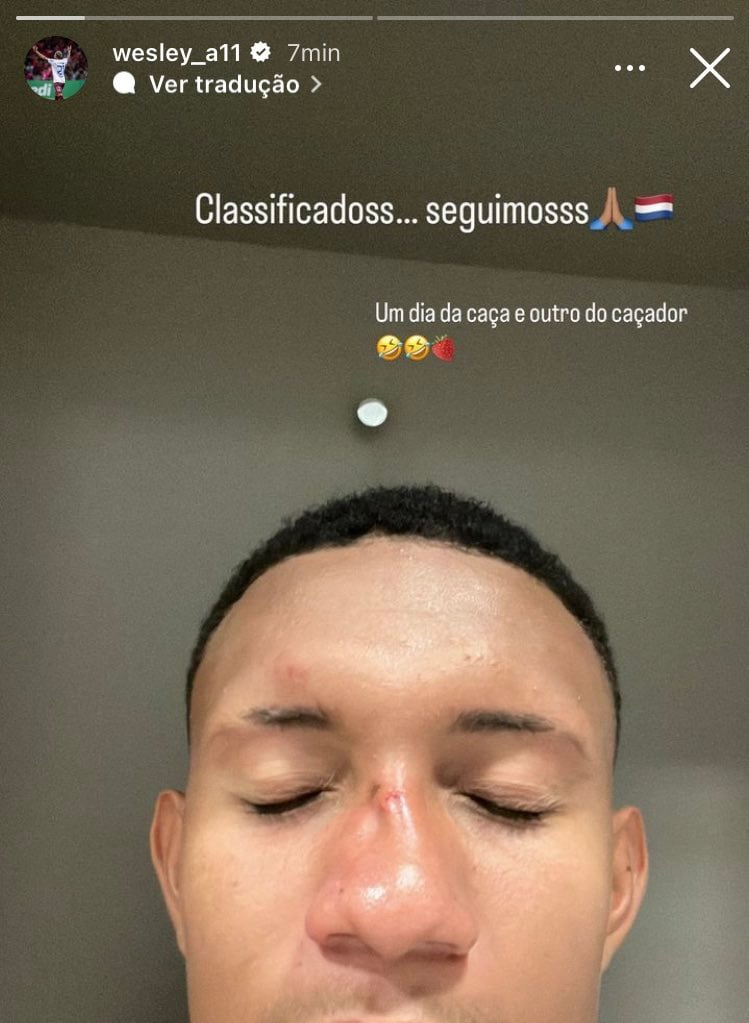 Herói da classificação do Caxias sobre o Internacional, atacante exibe  fratura sofrida no rosto após confusão - Lance!